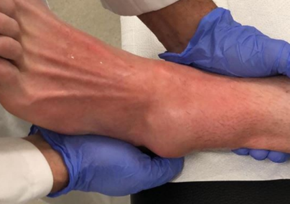 Incredibile, Crutchlow di nuovo infortunato: rompe i legamenti della caviglia scivolando in infermeria