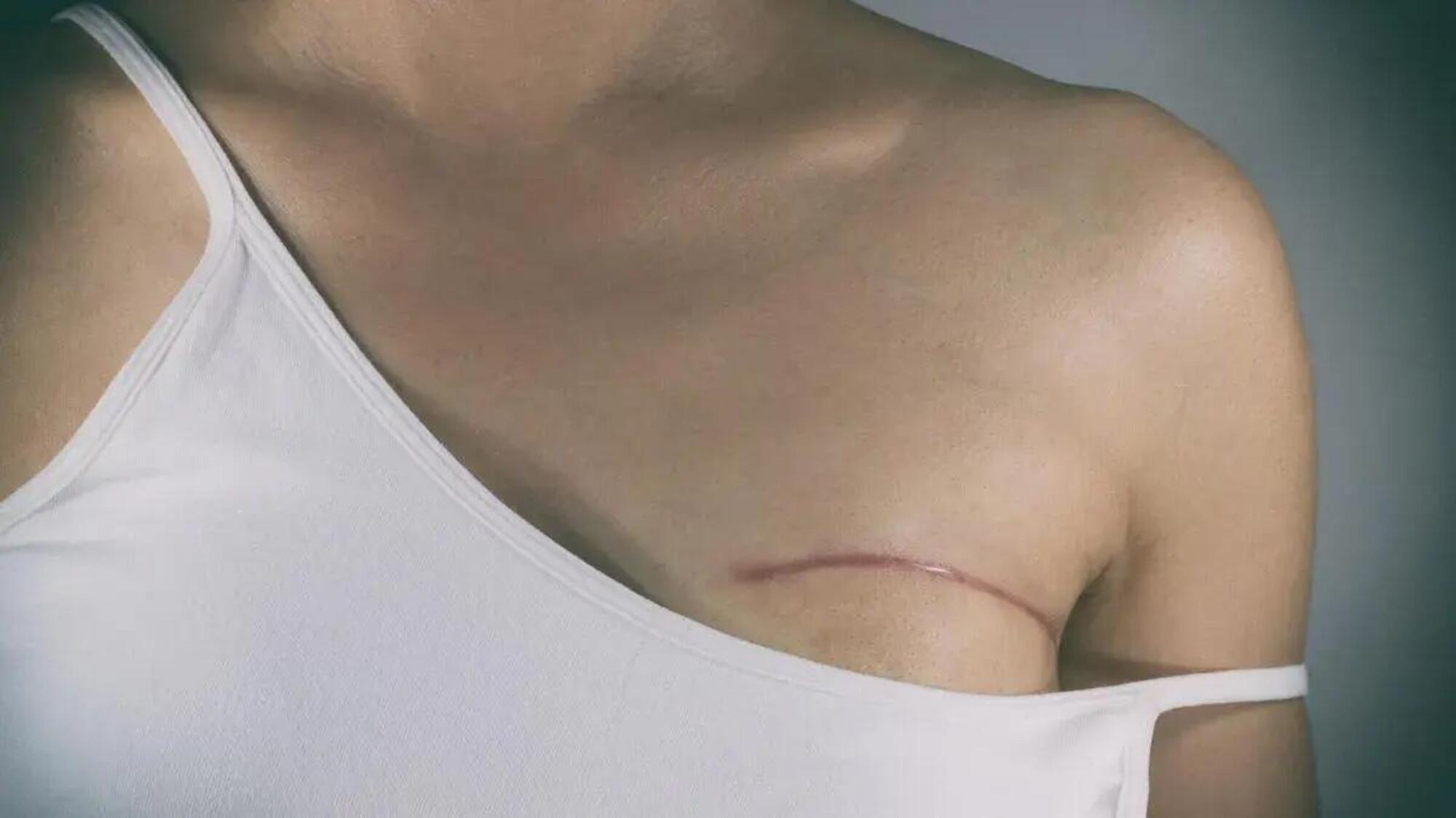 Il corpo di una donna dopo la mastectomia