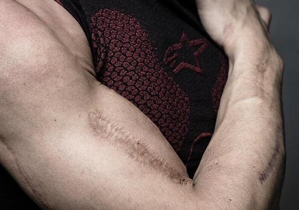 Marc Marquez risponde ai tatuaggi con le cicatrici e ammette: &ldquo;Il mio braccio chiede attenzioni&rdquo;