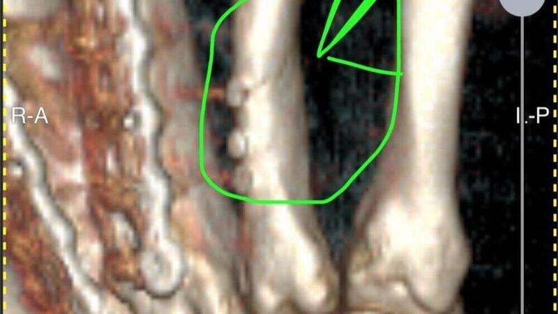 SBK 2025. Petrucci si &egrave; infortunato alla mano destra. Dichiarato unfit all&#039;Estoril