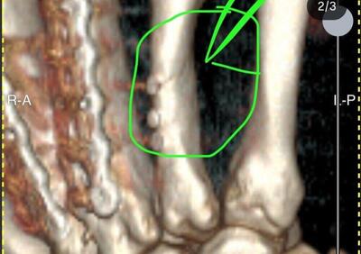 SBK 2025. Petrucci si è infortunato alla mano destra. Dichiarato unfit all'Estoril