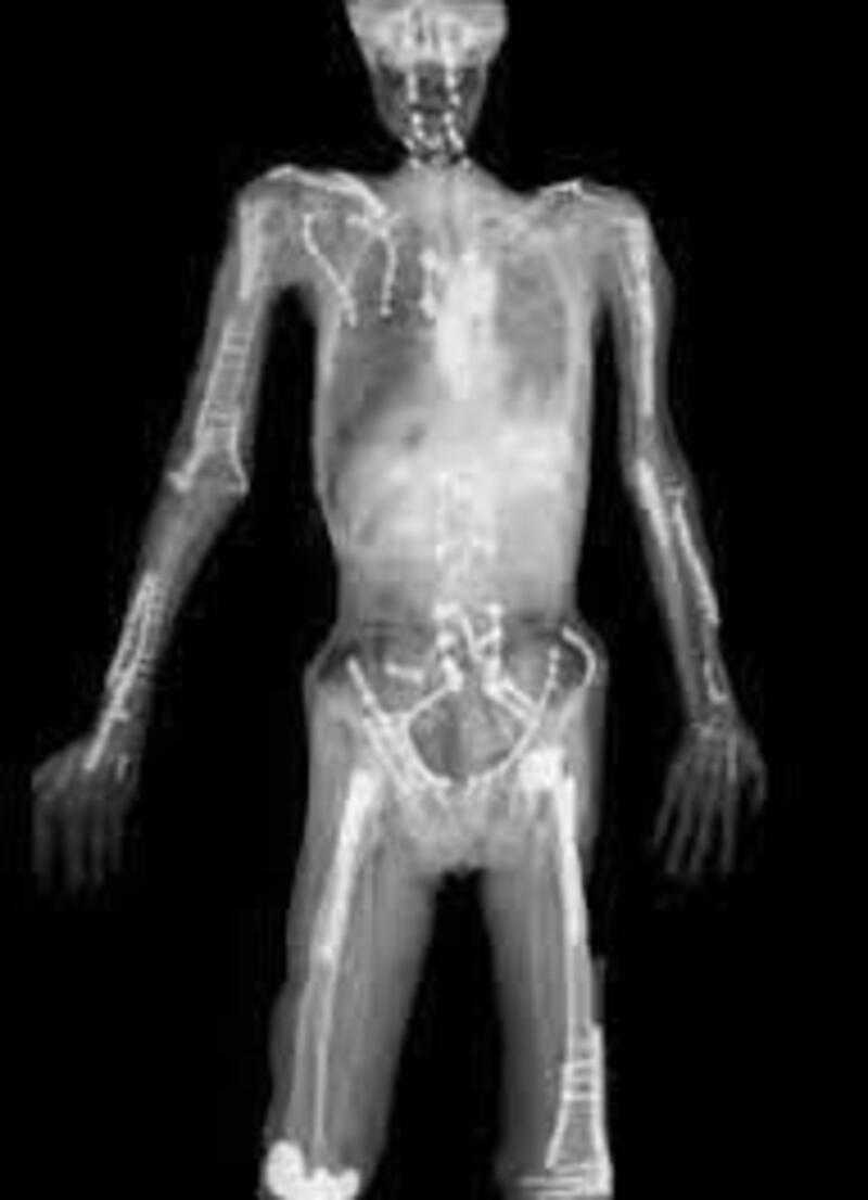 Ecco la radiografia di Travis Pastrana