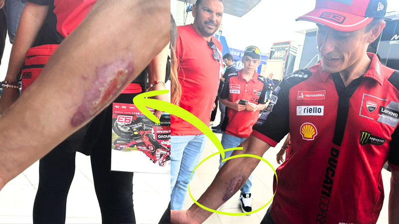 MM mostra l'abrasione al braccio destro, che si &egrave; causato con la caduta del venerd&igrave; del Texas